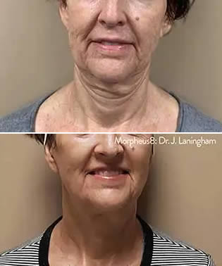 morpheus8 before and after